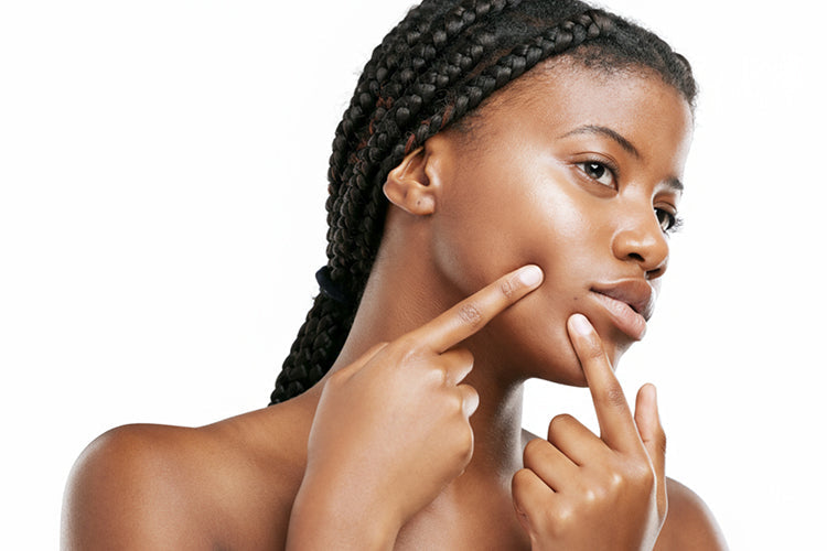 Model highlighting areas where makeup usually cakes or breaks out